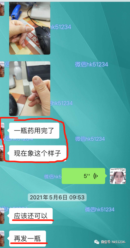 灰指甲怎么才能根治