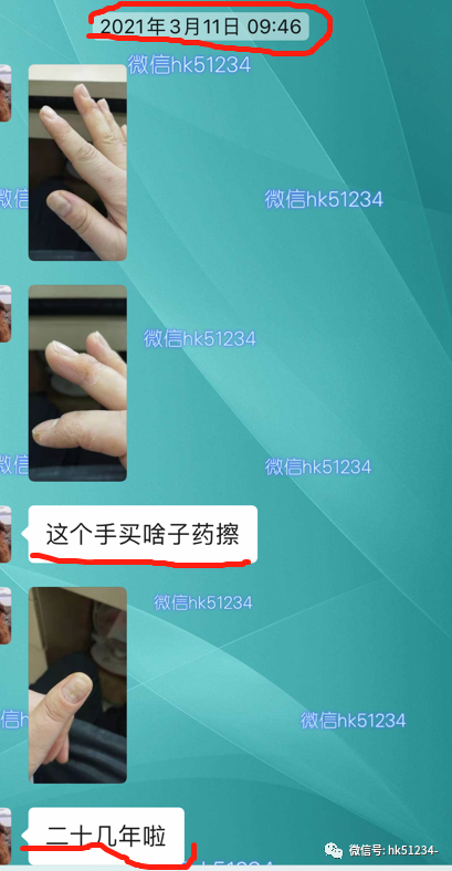 灰指甲怎么才能根治